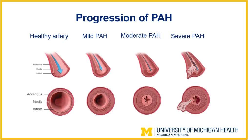 Mild store pulmonary hypertension