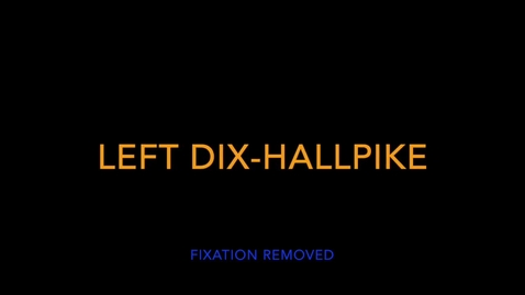 Thumbnail for Left Dix-Hallpike Increased nystagmus with fixation
