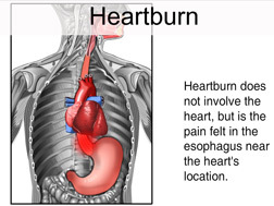 heartburn location