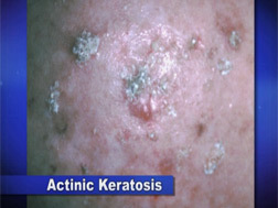 Actinic Keratosis: The Link between Chronic Sun Damage and Skin Cancer -  Films Media Group