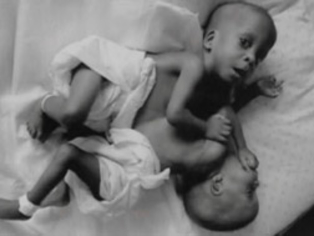 conjoined twins ethical issues