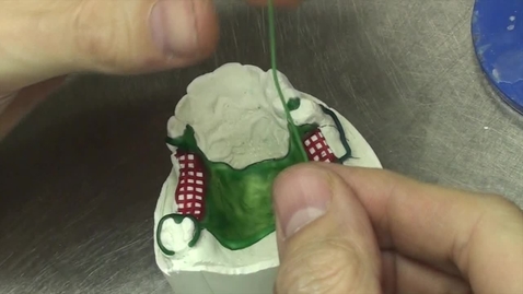 Thumbnail for Kennedy Class II Mod.1: Wax patterning - Finishing beading