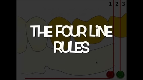 Thumbnail for Four line rule for gingival approaching clasps