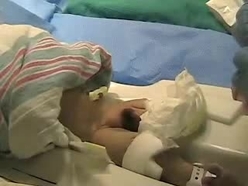 Gomco Clamp Technique Newborn Nursery Stanford Medicine