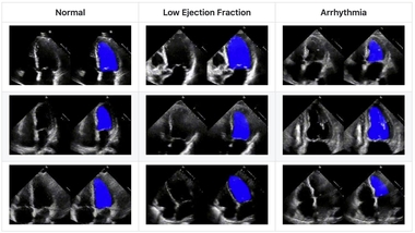 Algorithm Helps Detect Heart Abnormalities Scope