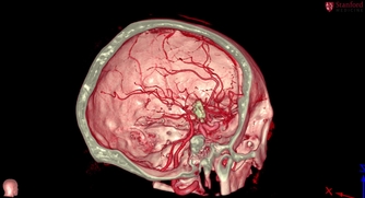 Craniopharyngioma | Skull Base Surgery | Stanford Medicine