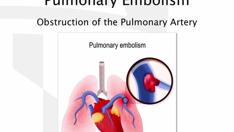 Thumbnail for entry 120.516 M5B Pulmonary Embolism - Sullivan