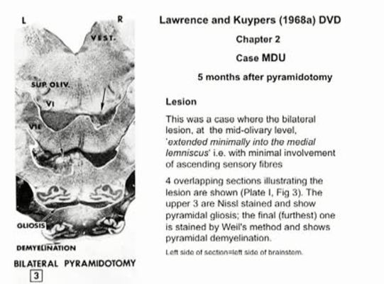 Thumbnail for the embedded element "5 months after pyramidotomy | K02_Chapter_02"