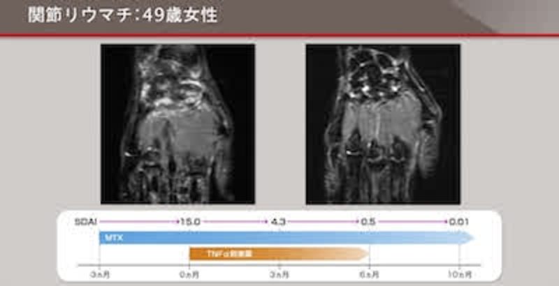 RA画像診断マスターコース　第１回「MRI検査でみる関節リウマチの滑膜炎と骨変化」