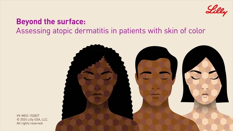 Beyond the Surface: Assessing Atopic Dermatitis in Patients with Skin of Color