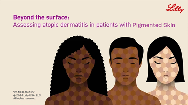 Beyond the Surface: Assessing Atopic Dermatitis in Patients with Skin of Color