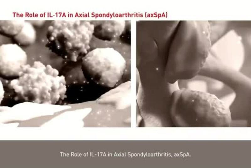 The Role of IL-17A in Axial Spondyloarthritis (axSpA)