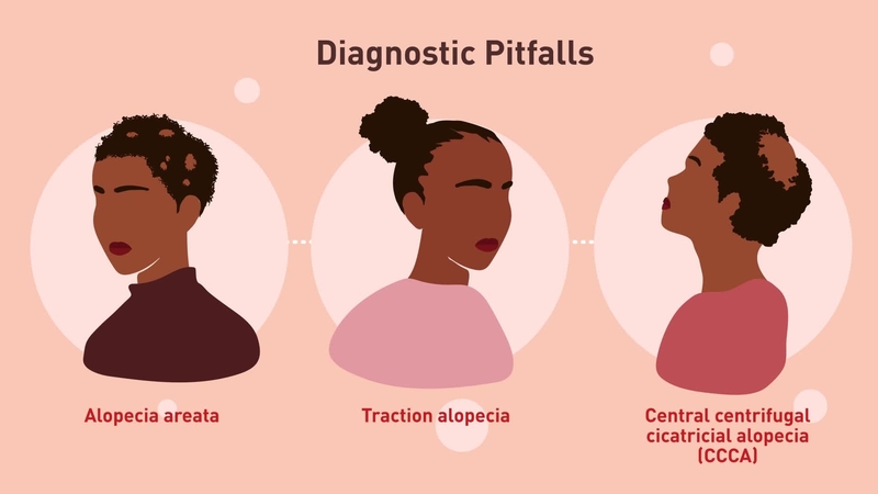 Alopecia Areata in Black Patients: Module 3 - Diagnostic Pitfalls in Alopecia Areata