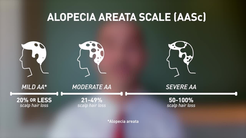 Assessing Alopecia Areata Patient Severity | Chapter 2: What is the Alopecia Areata Scale – AASc?