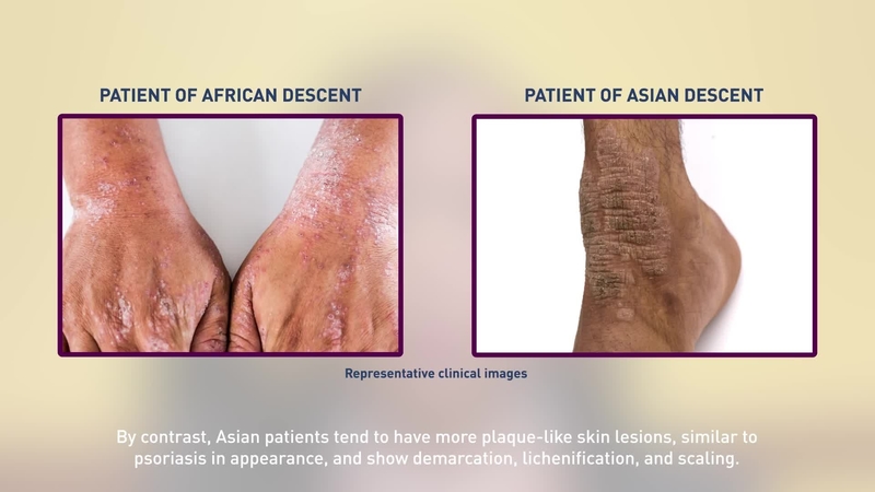 Eczchanges: A case study approach to treating and managing atopic dermatitis in patients with skin of color with Dr Valerie Callender