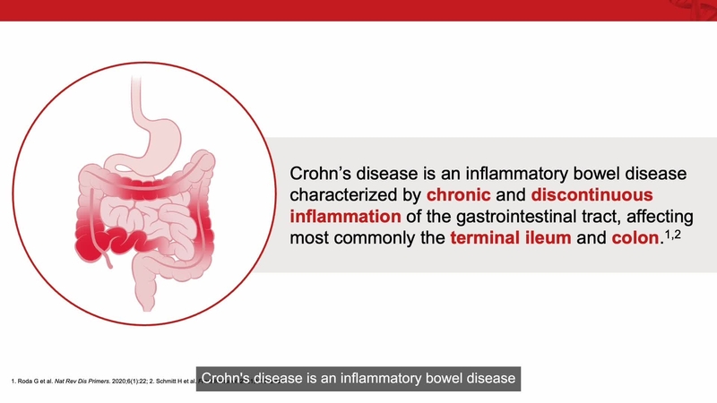 Crohn’s Disease Mechanism of Disease