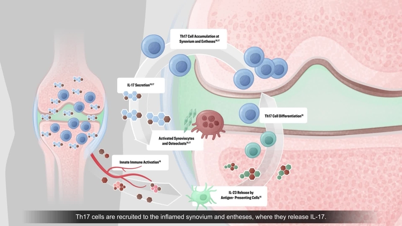 The Obesity-Psoriatic Arthritis Connection: Understanding the Pathophysiology