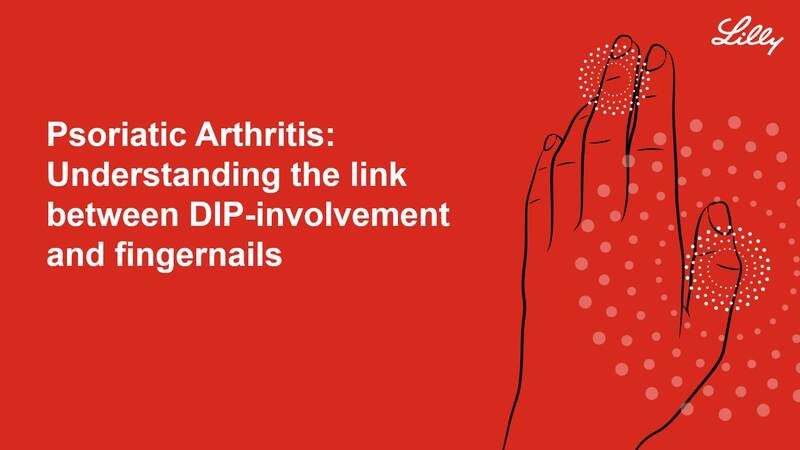 Psoriatic Arthritis: Understanding the link between DIP-involvement and fingernails