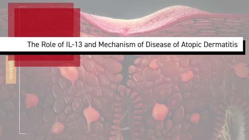 The Role of IL-13 and Mechanism of Disease in Atopic Dermatitis