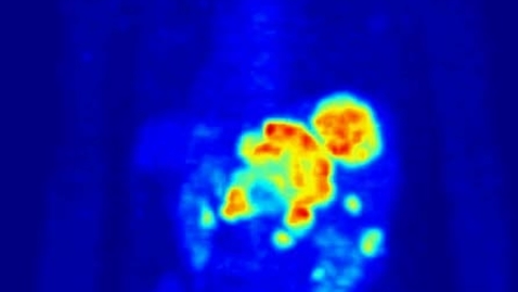 Thumbnail for Whole-body PET  scan using  Fluorine-18