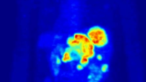 Thumbnail for entry Whole-body PET  scan using  Fluorine-18