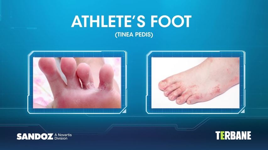 Athlete's Foot (Tinea Pedis)