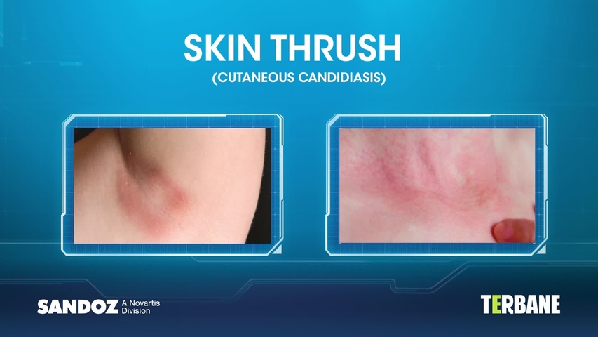 Cutaneous deals candidiasis treatments