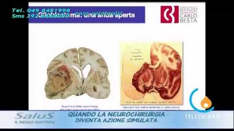 Thumbnail for Quando la neurochirurgia diventa azione simulata