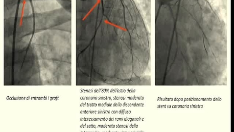 Thumbnail for entry “Of coronary arteries and men”: la lotta tra un paziente dializzato e le sue coronarie. Implicazioni per il rischio cardiovascolare nel paziente con malattia renale cronica