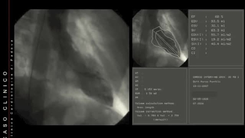 Thumbnail for entry Stenosi aortica senile