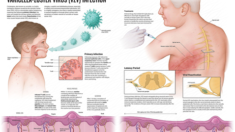 Thumbnail for Varicella e Herpes Zoster