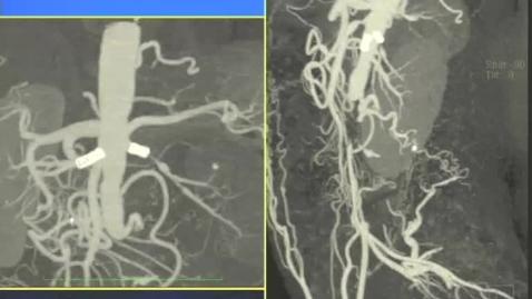 Thumbnail for Ipertensione arteriosa resistente in giovane donna: opzioni di trattamento alla luce dei risultati dello studio ASTRAL