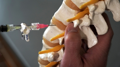 Two-step method patches herniated discs - Cornell Video