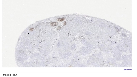 Thumbnail for entry 07-05 Lymph Node, CD20 Immunohistochemical Stain