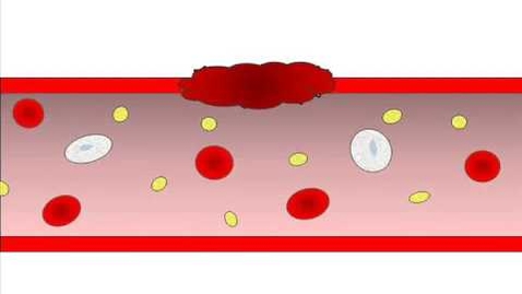 Thumbnail for entry VM 518-Hemostasis - Helpful Blood Clotting (YouTube video-no captions)