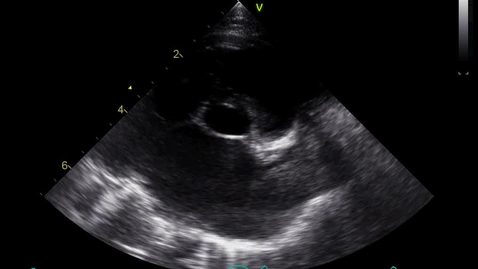 Thumbnail for entry VM 518-Buster case: Echocardiography left atrium