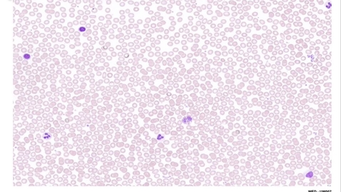Thumbnail for entry 07-01 Cells in Peripheral Blood Smear