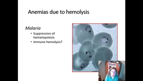 Thumbnail for entry IM618 - Anemia 3: Hemolysis and Impaired Production