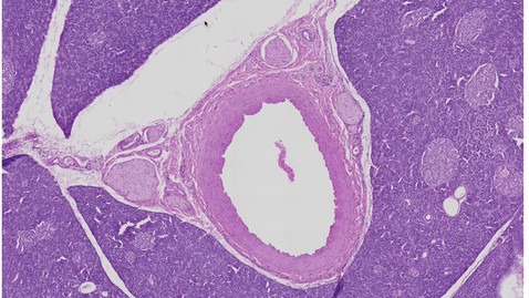 Thumbnail for entry Q11 Pancreas Neurovascular Bundle