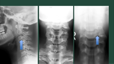 Thumbnail for Unit 4 Module 1 - Spine evaluation