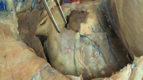 Thumbnail for entry VM 518-Left side of thorax heart and related structures