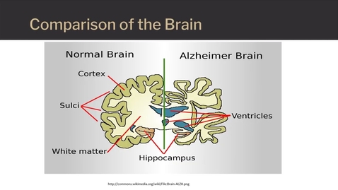 Thumbnail for entry Alzheimer's disease